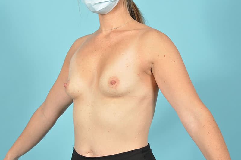 Breast Augmentation Before & After Image Patient 29643