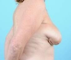 Fat Grafting To The Breast Before & After Image Patient 27000