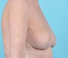 Fat Grafting To The Breast Before & After Image Patient 27000