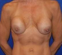 Breast Implant Correction Before & After Image Patient 27001