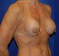 Breast Implant Correction Before & After Image Patient 27001