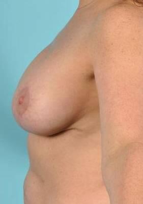 Breast Implant Correction Before & After Image