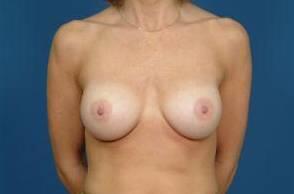 Breast Implant Correction Before & After Image Patient 27003