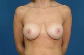 Breast Implant Correction Before & After Image