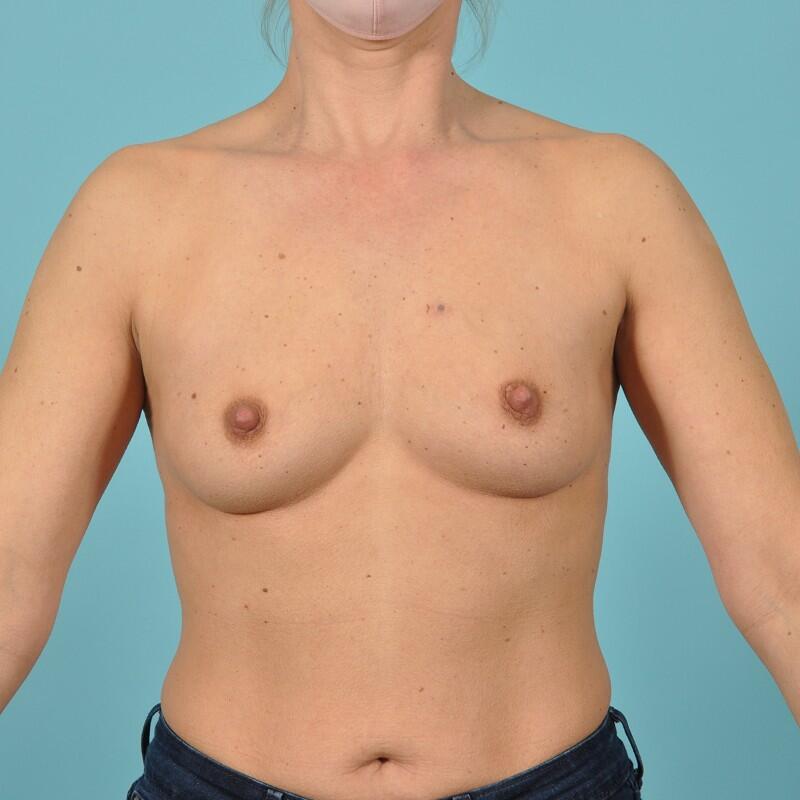 Breast Implant Correction Before & After Image Patient 27008