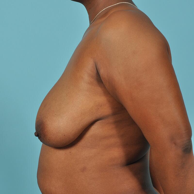 Breast Lift Before & After Image