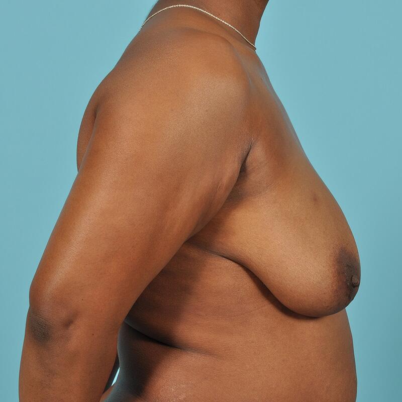 Breast Lift Before & After Image Patient 27501