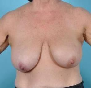 Breast Lift Before & After Image Patient 27506