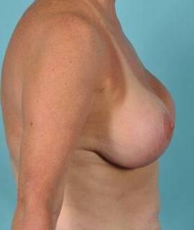 Breast Lift Before & After Image Patient 27506