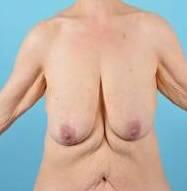 Breast Lift Before & After Image Patient 27508