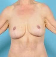 Breast Lift Before & After Image Patient 27508