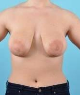 Breast Lift Before & After Image Patient 27509