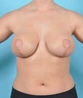 Breast Lift Before & After Image