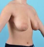 Breast Lift Before & After Image Patient 27509