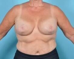 Breast Lift Before & After Image Patient 27510
