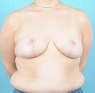 Breast Reduction For Women Before & After Image