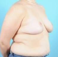 Breast Reduction For Women Before & After Image