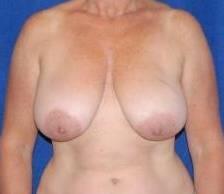 Breast Reduction For Women Before & After Image