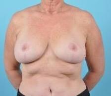 Breast Reduction For Women Before & After Image