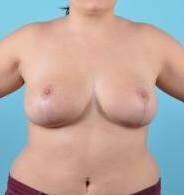 Breast Reduction For Women Before & After Image