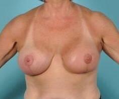 Breast Reduction For Women Before & After Image