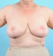 Breast Reduction For Women Before & After Image