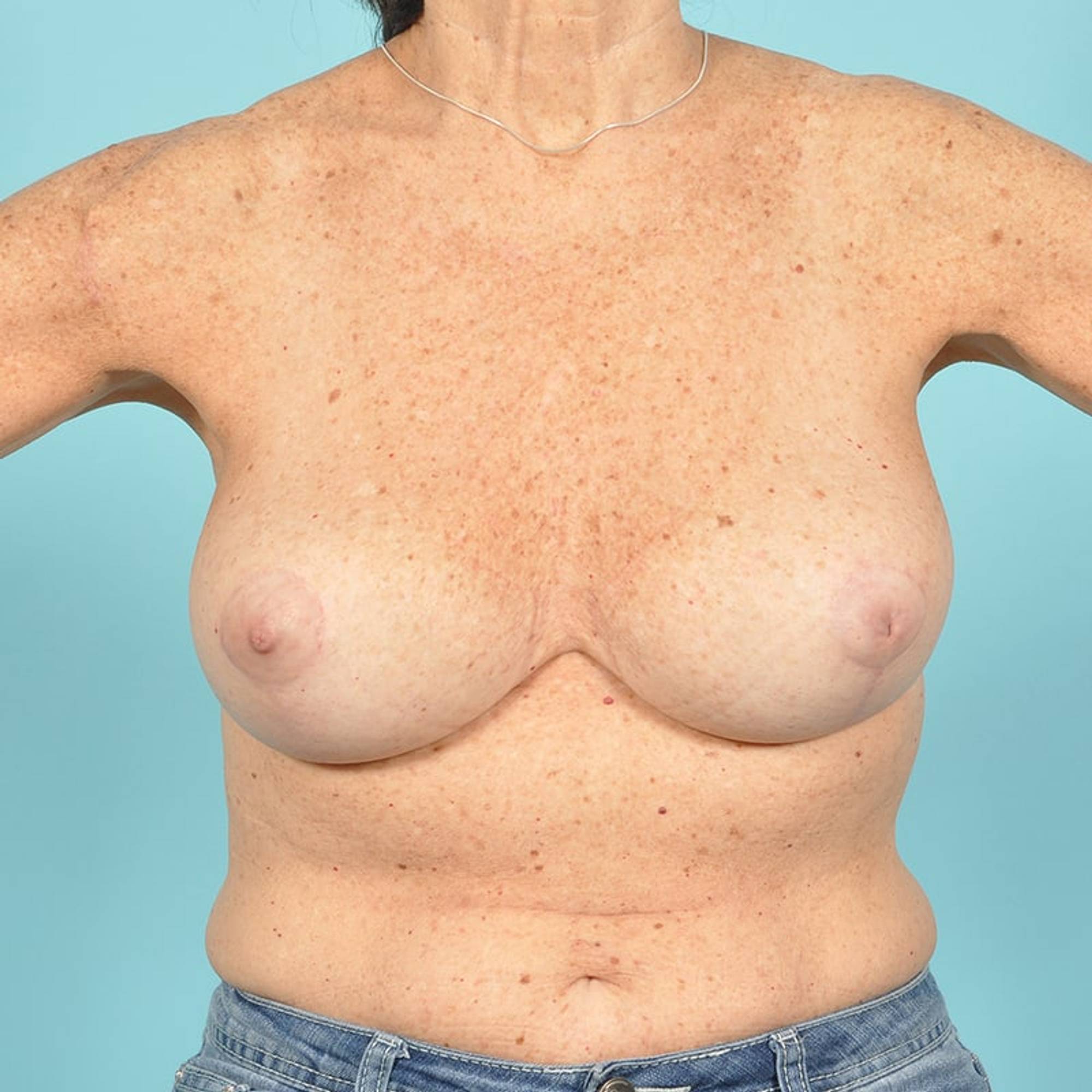  Before & After Image