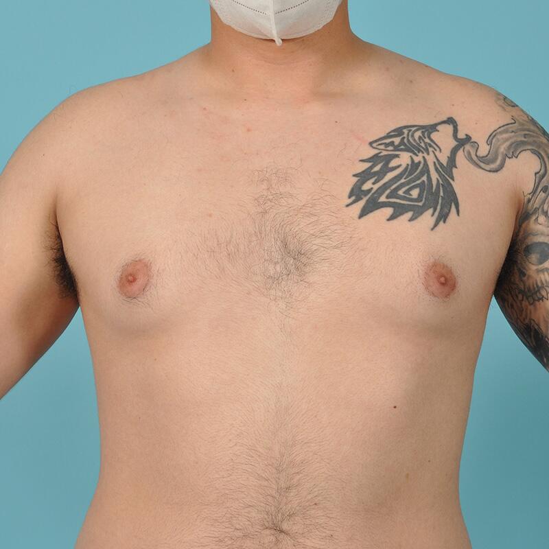 Breast Reduction For Men Before & After Image