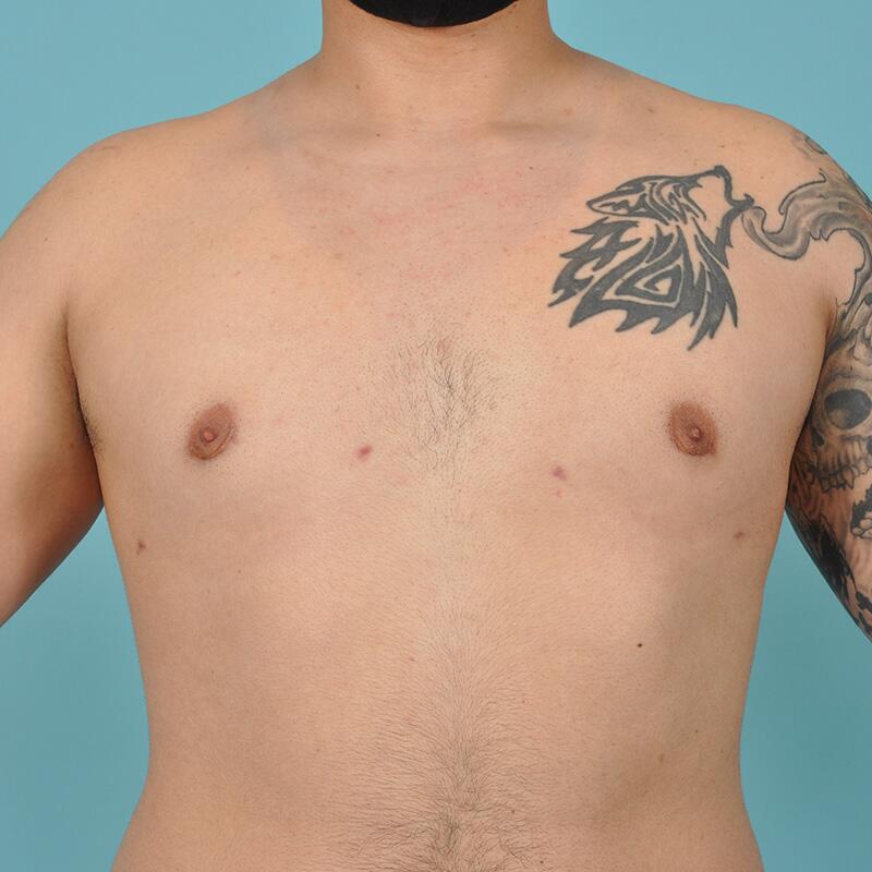 Breast Reduction For Men Before & After Image