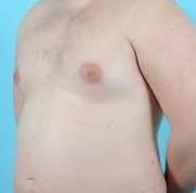 Breast Reduction For Men Before & After Image