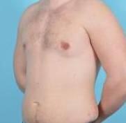 Breast Reduction For Men Before & After Image