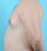 Breast Reduction For Men Before & After Image Patient 27290