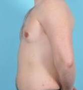 Breast Reduction For Men Before & After Image