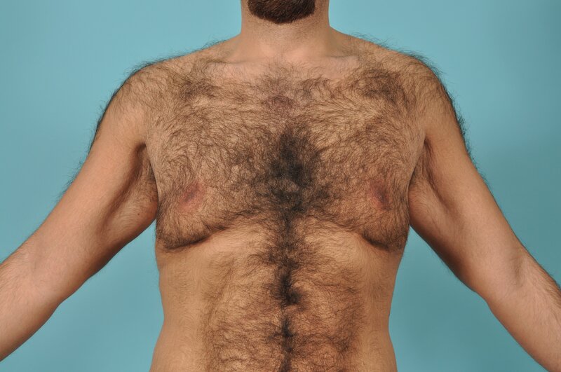 Breast Reduction For Men Before & After Image Patient 27295