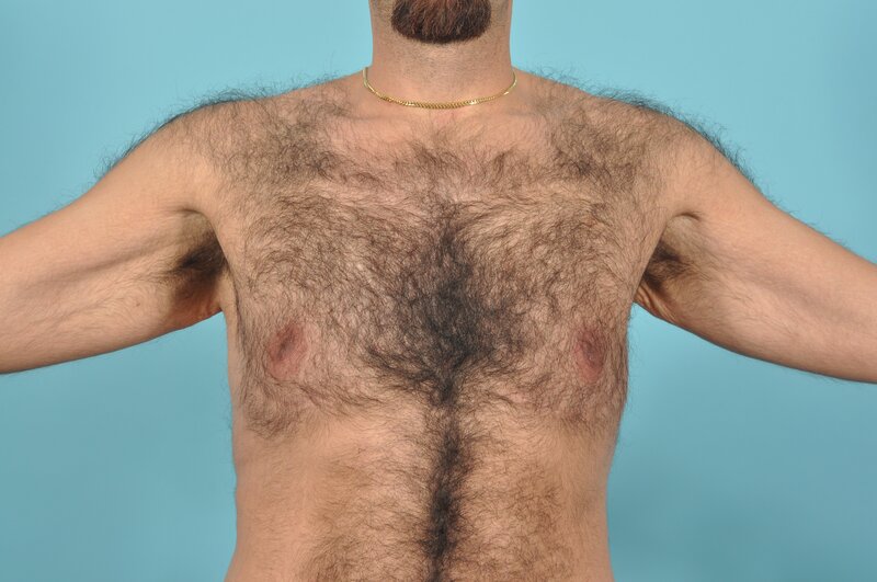 Breast Reduction For Men Before & After Image