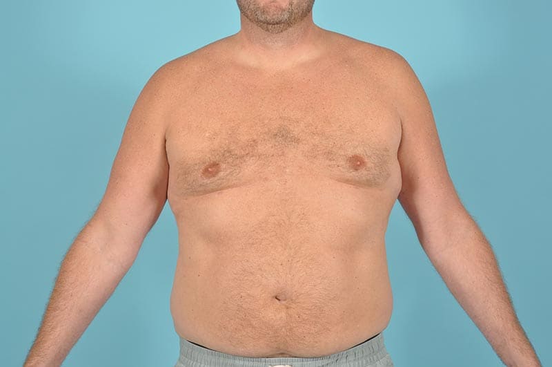 Breast Reduction For Men Before & After Image Patient 304650