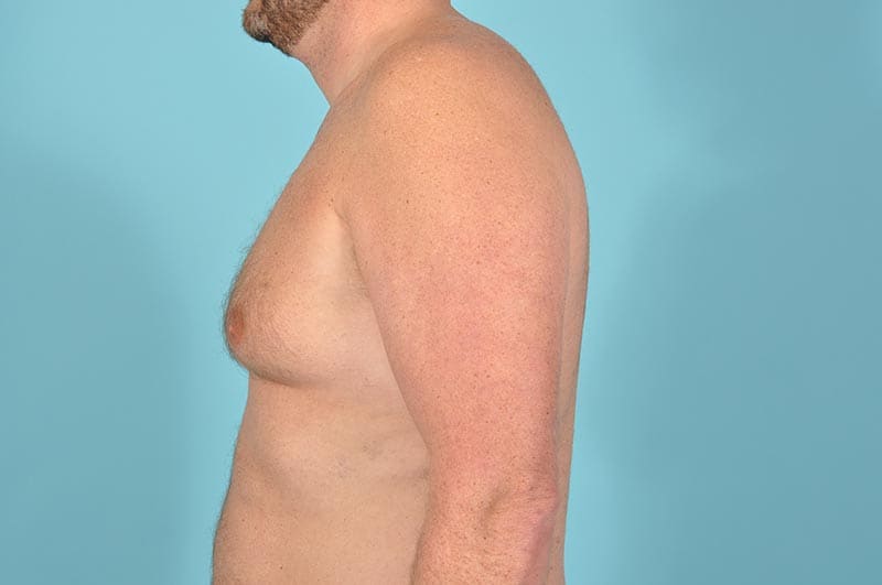 Breast Reduction For Men Before & After Image