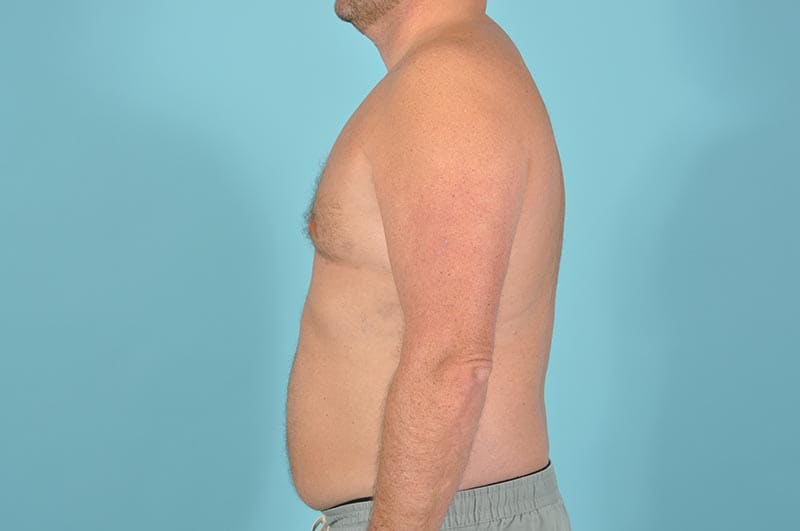 Breast Reduction For Men Before & After Image