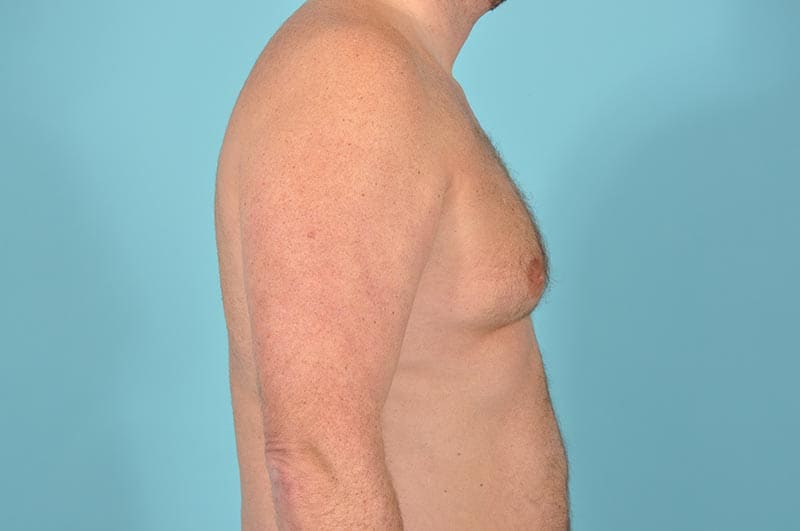 Breast Reduction For Men Before & After Image Patient 304650