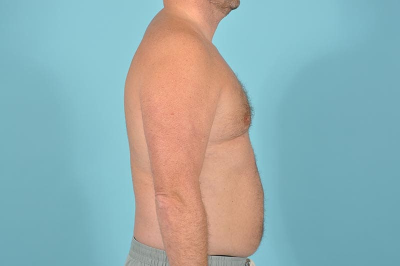 Breast Reduction For Men Before & After Image