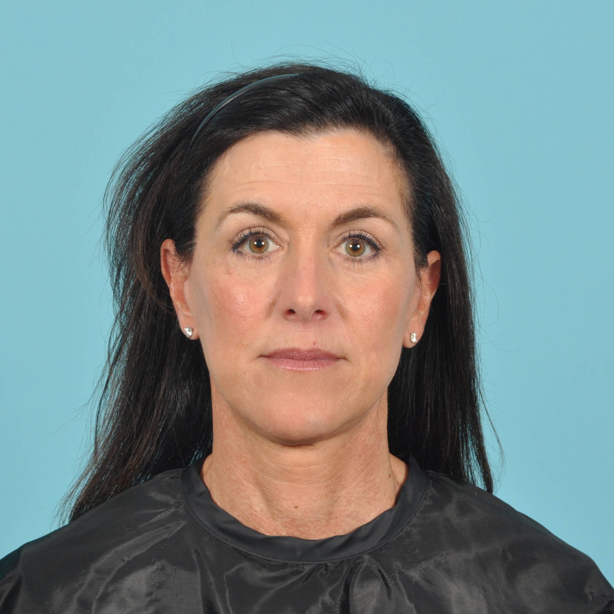Blepharoplasty Before & After Image