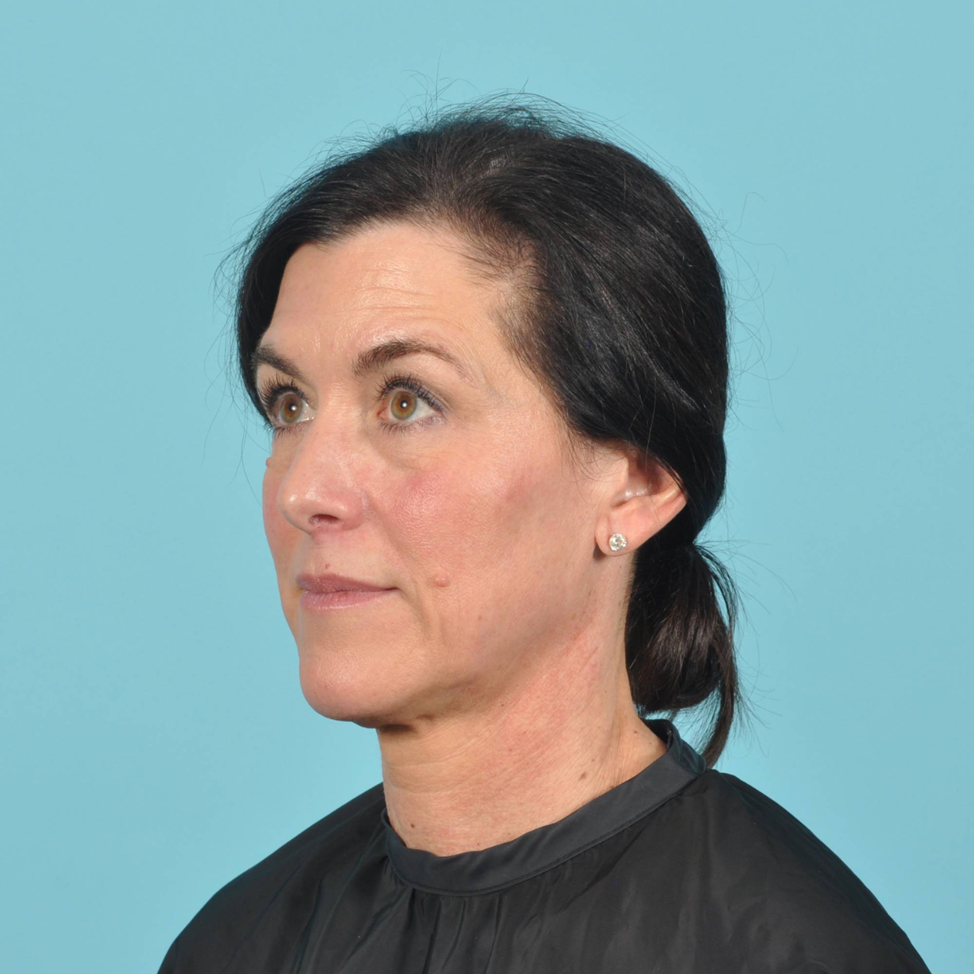 Blepharoplasty Before & After Image