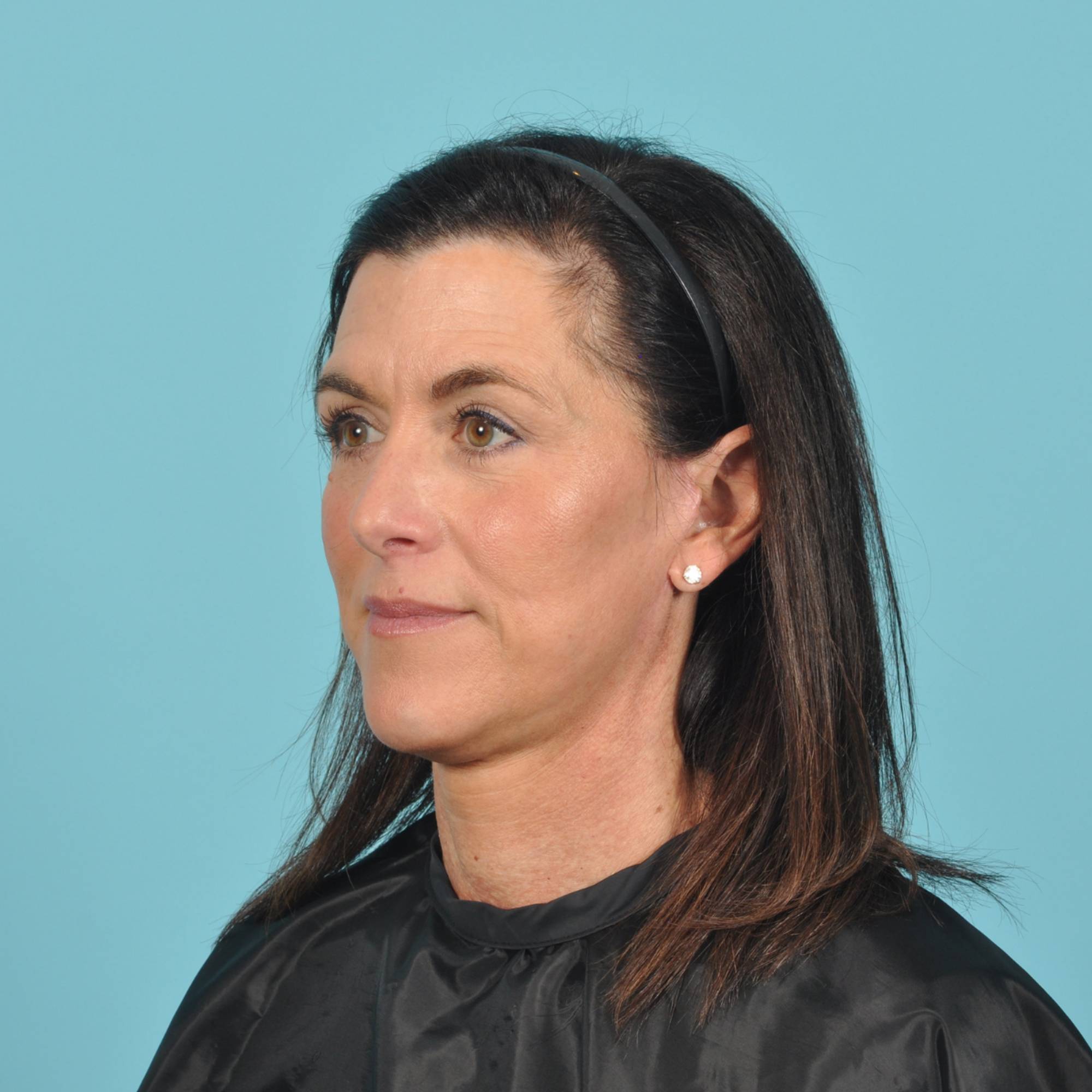 Blepharoplasty Before & After Image