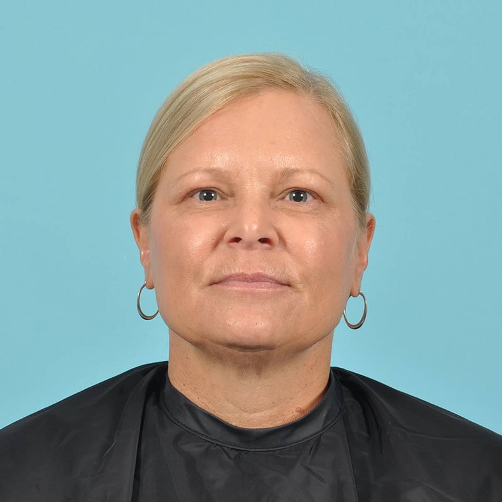 Blepharoplasty Before & After Image