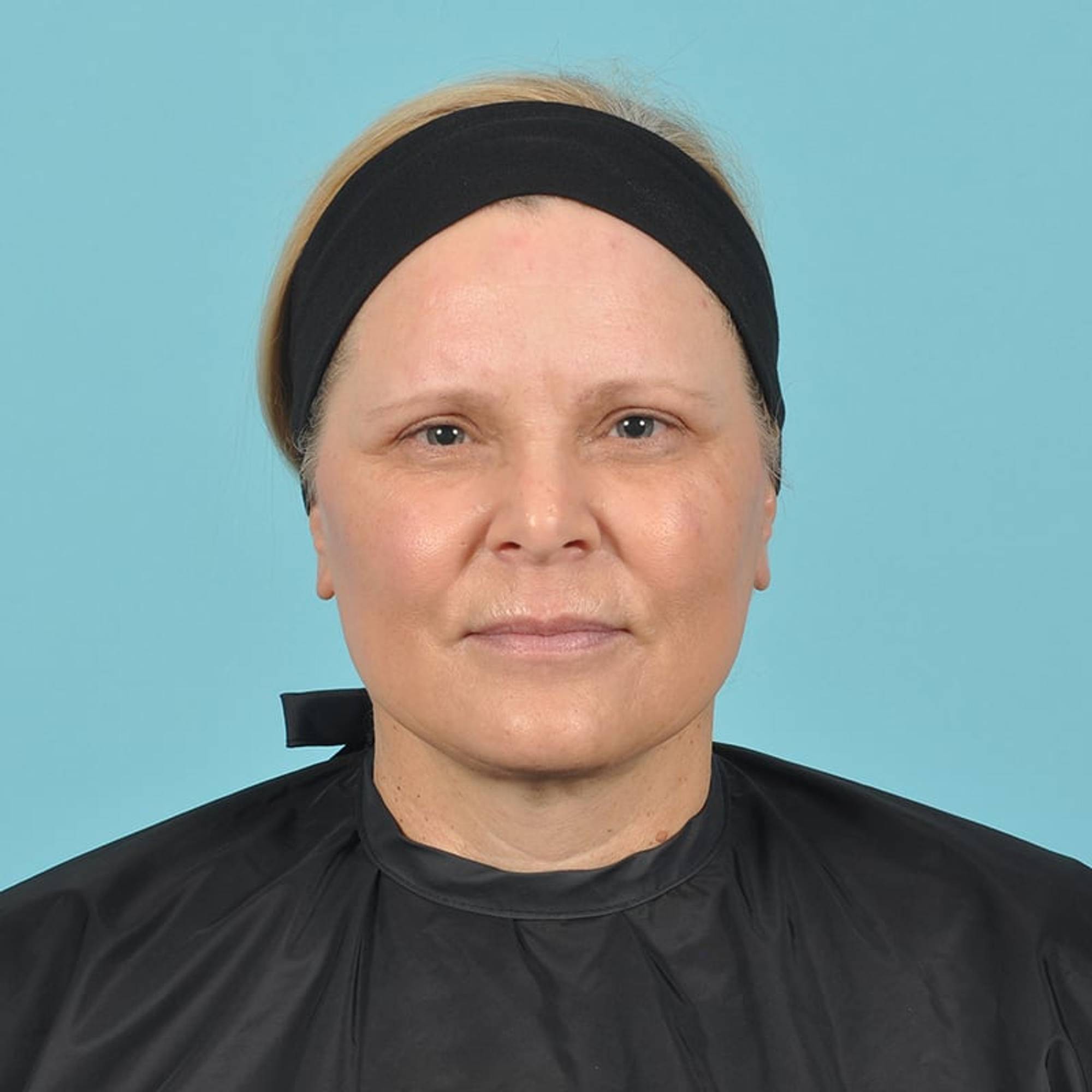 Blepharoplasty Before & After Image