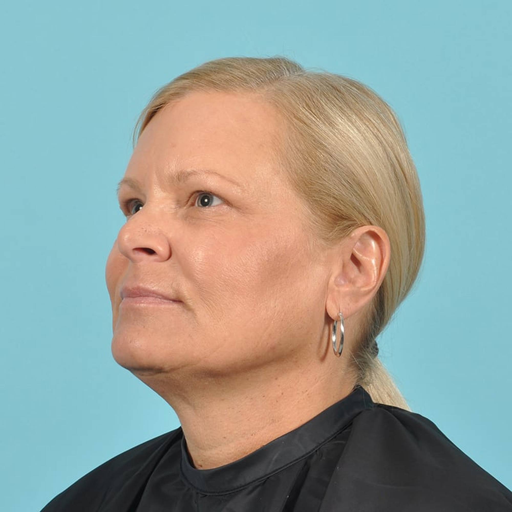 Blepharoplasty Before & After Image