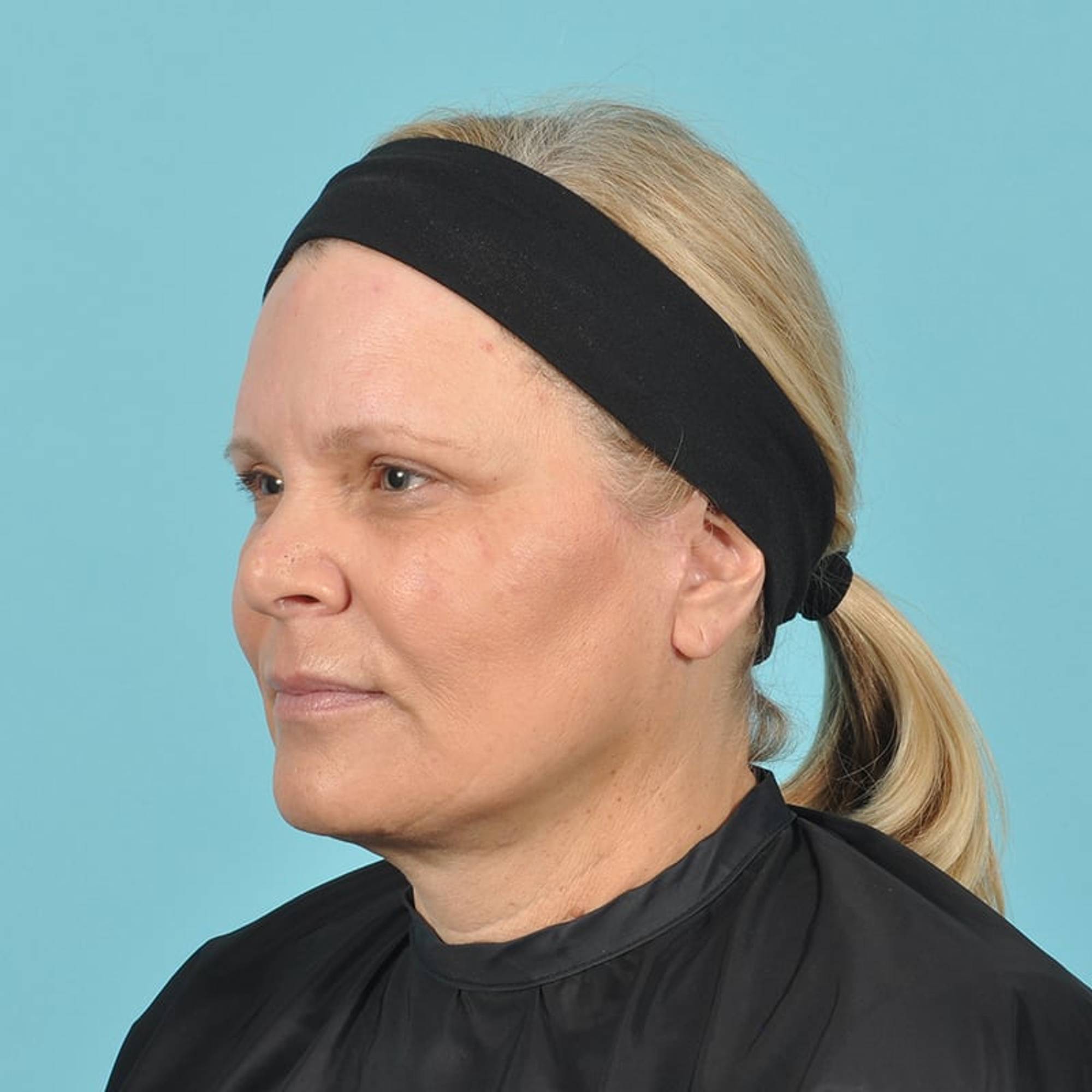Blepharoplasty Before & After Image