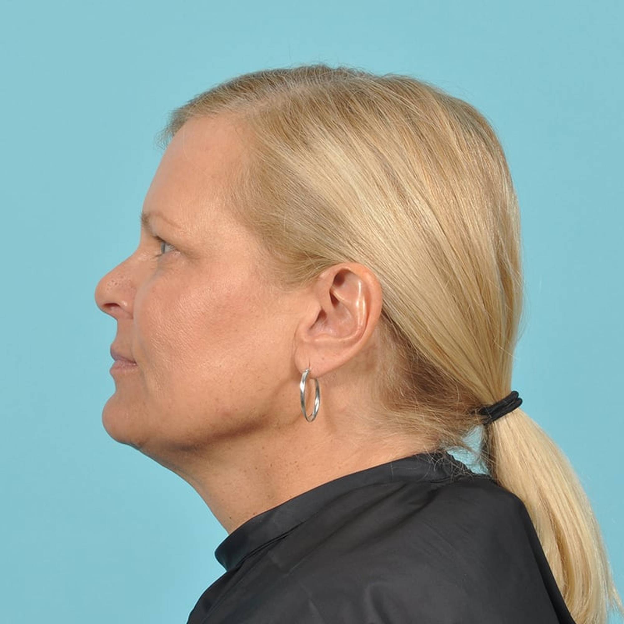 Blepharoplasty Before & After Image