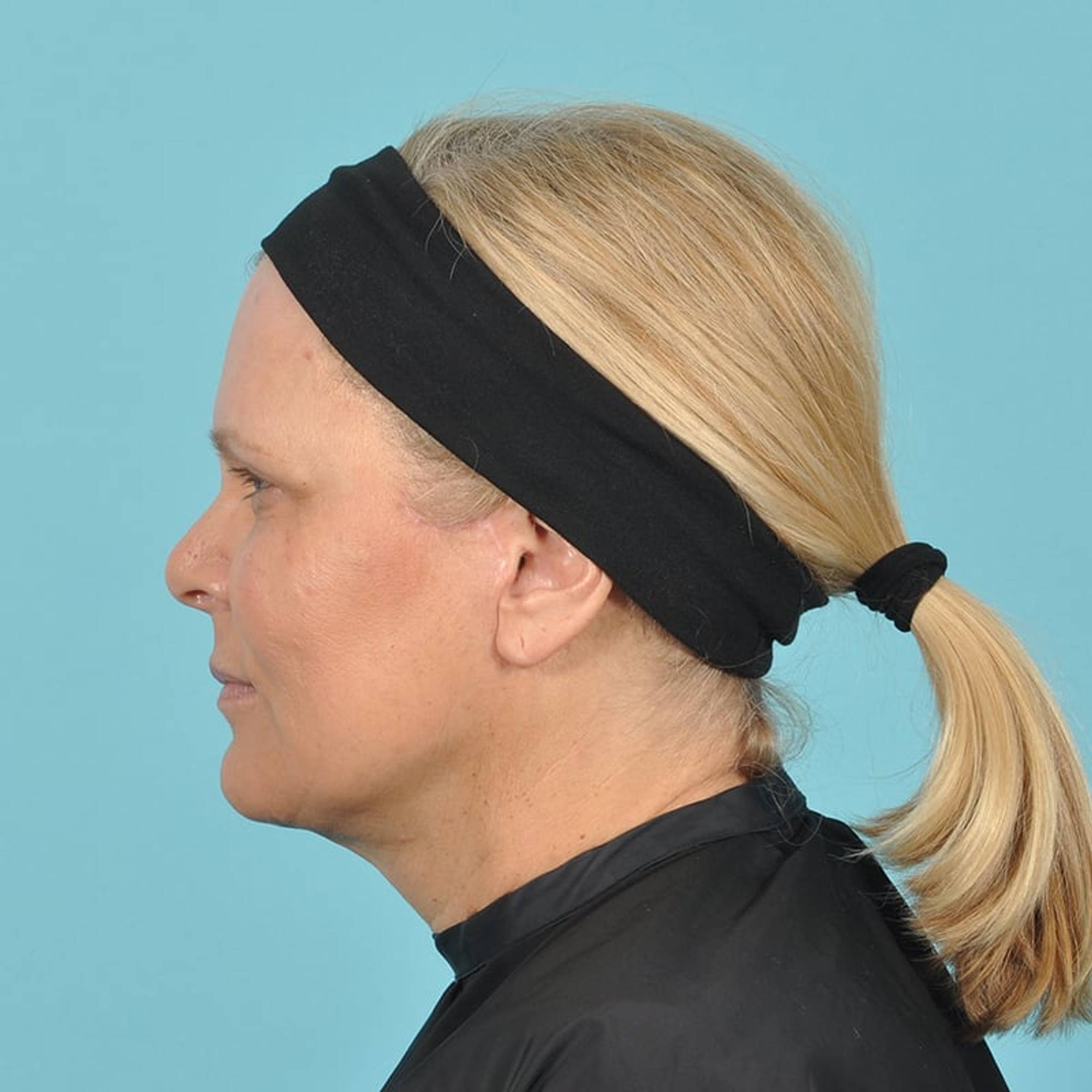Blepharoplasty Before & After Image