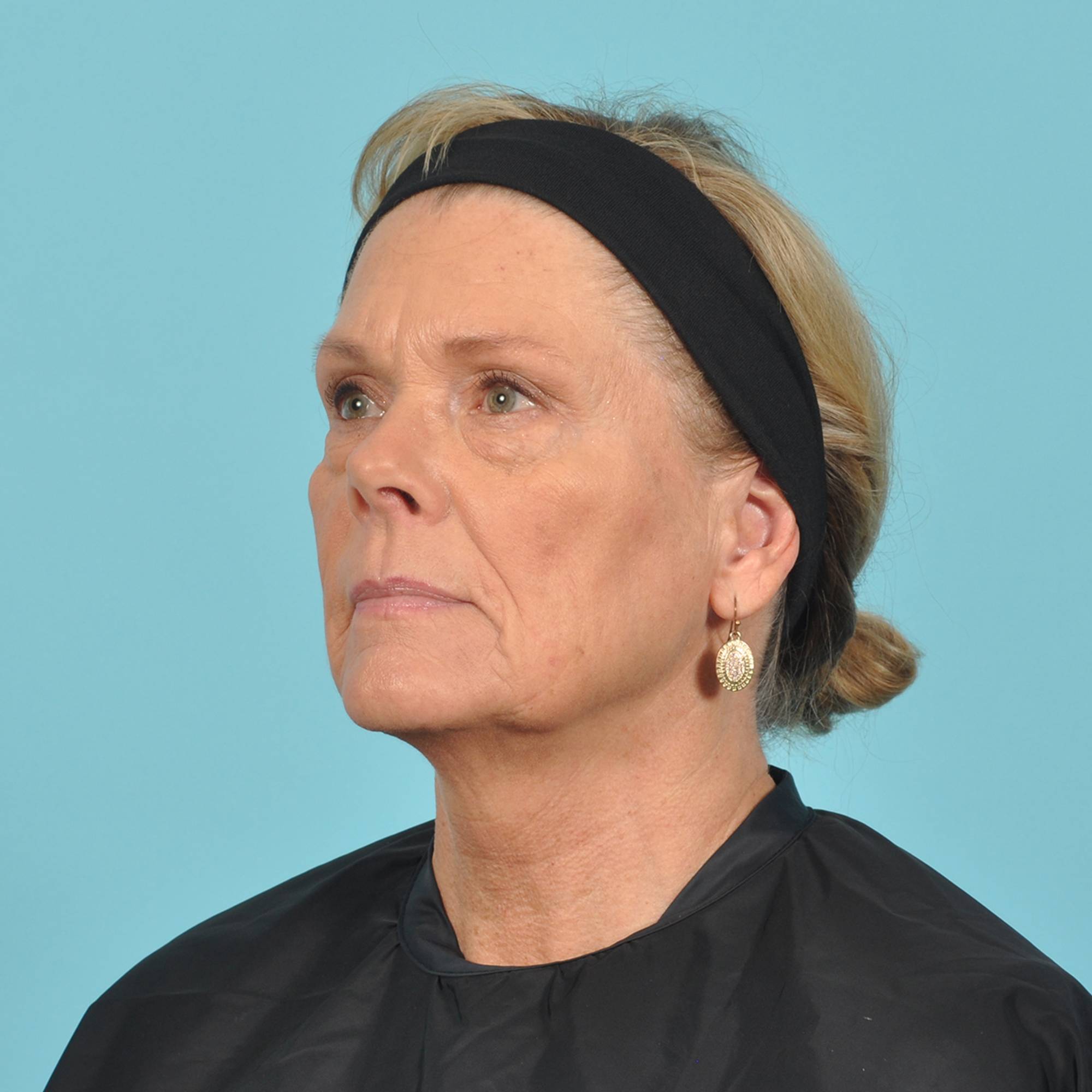 Blepharoplasty Before & After Image